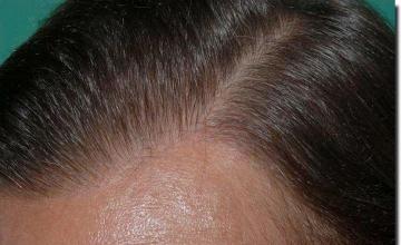 Hair restoration procedure results