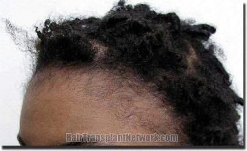 Hair restoration procedure results