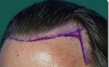 Hair restoration procedure results