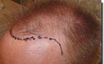 Hair restoration procedure results