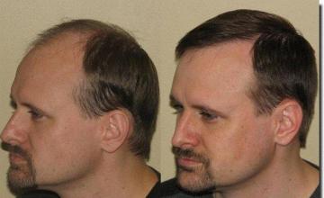 Hair restoration procedure results