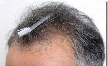 Hair restoration procedure results