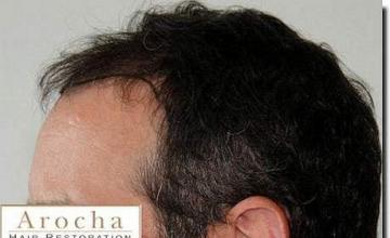 Hair restoration procedure results