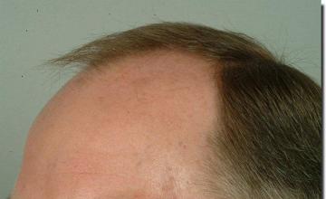 Hair restoration procedure results