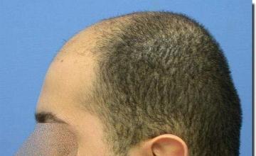 Hair restoration procedure results