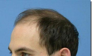 Hair restoration procedure results