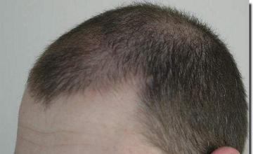 Hair restoration procedure results