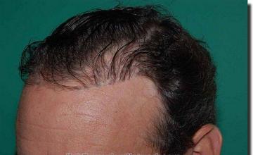 Hair restoration procedure results