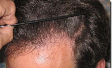 Hair restoration procedure results