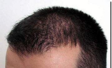 Hair restoration procedure results