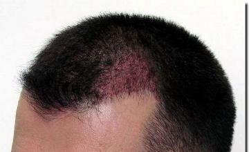 Hair restoration procedure results