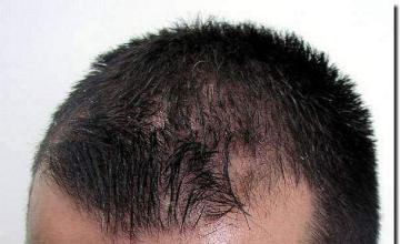 Hair restoration procedure results