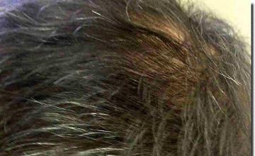 Hair restoration procedure results