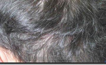 Hair restoration procedure results