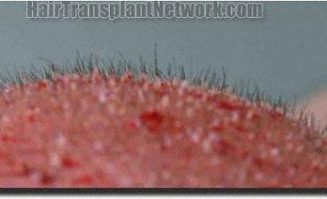 Hair restoration procedure results