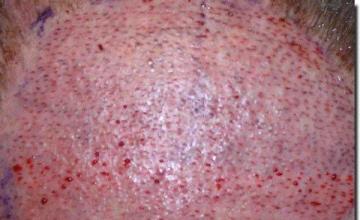 Hair restoration procedure results
