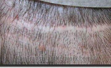 Hair restoration procedure results