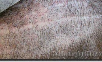 Hair restoration procedure results