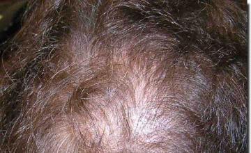 Hair restoration procedure results