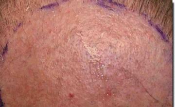 Hair restoration procedure results