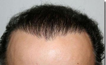 Hair restoration procedure results