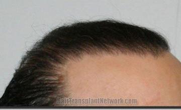 Hair restoration procedure results