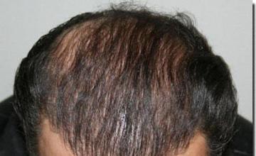Hair restoration procedure results