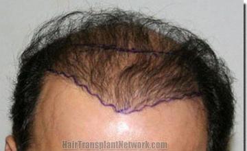 Hair restoration procedure results