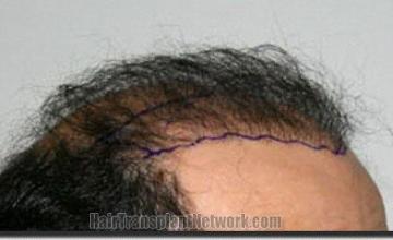 Hair restoration procedure results