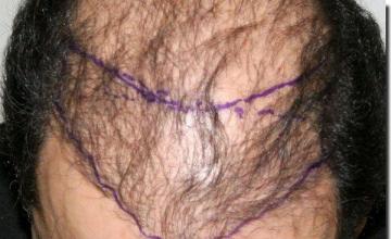 Hair restoration procedure results
