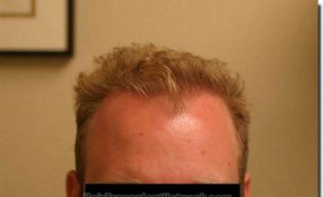 Hair restoration procedure results