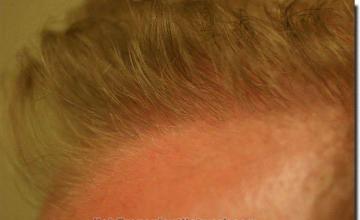 Hair restoration procedure results