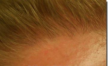 Hair restoration procedure results