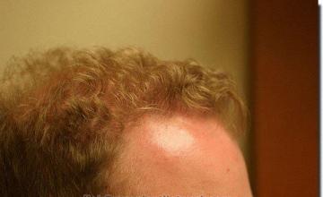 Hair restoration procedure results