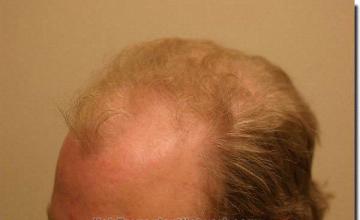 Hair restoration procedure results