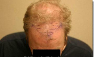 Hair restoration procedure results