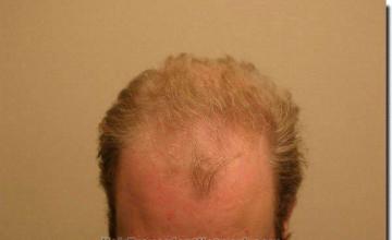 Hair restoration procedure results