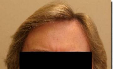 Hair restoration procedure results