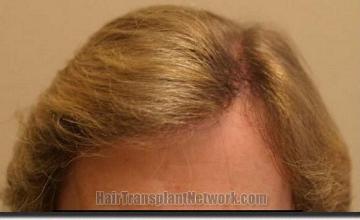 Hair restoration procedure results