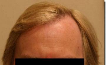 Hair restoration procedure results