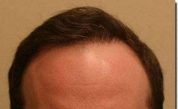 Hair restoration procedure results