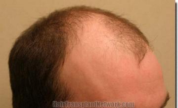 Hair restoration procedure results