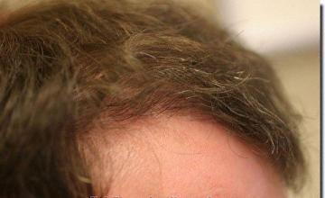 Hair restoration procedure results