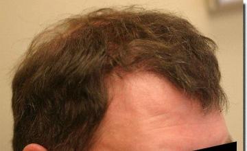 Hair restoration procedure results