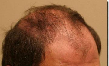 Hair restoration procedure results