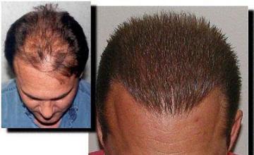 Hair restoration procedure results