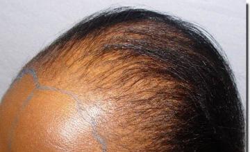 Hair restoration procedure results