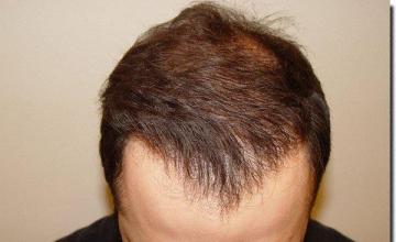 Hair restoration procedure results