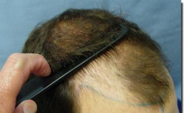 Hair restoration procedure results