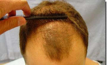 Hair restoration procedure results